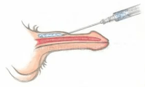 Suntikan asam hyaluronic